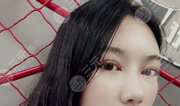 上睑下垂矫正案例后4个月