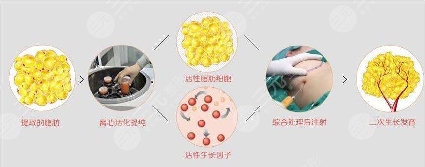 脂肪移植隆胸降低风险吗?