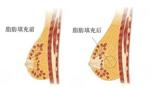 脂肪移植隆胸果能维持多久