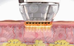 面部光子嫩肤手术可以祛痘吗？养成发光肌~