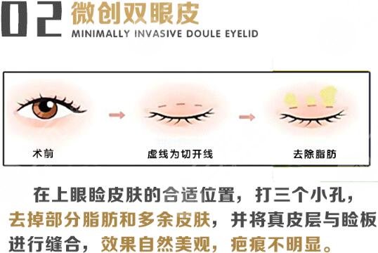 韩式微创双眼皮