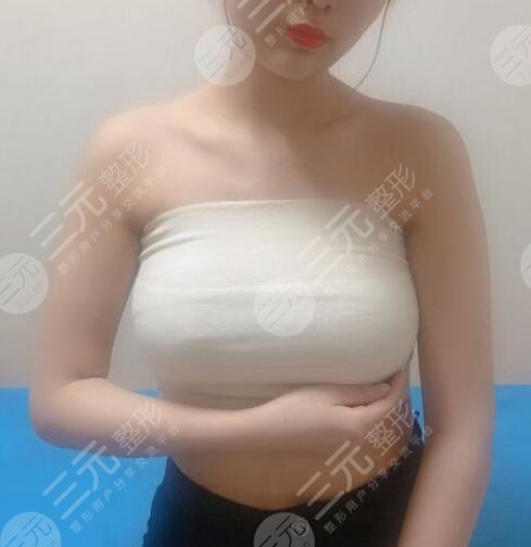穆大力隆胸案例3个月果图 医生个人简介分享,美胸必看!-三元整形网