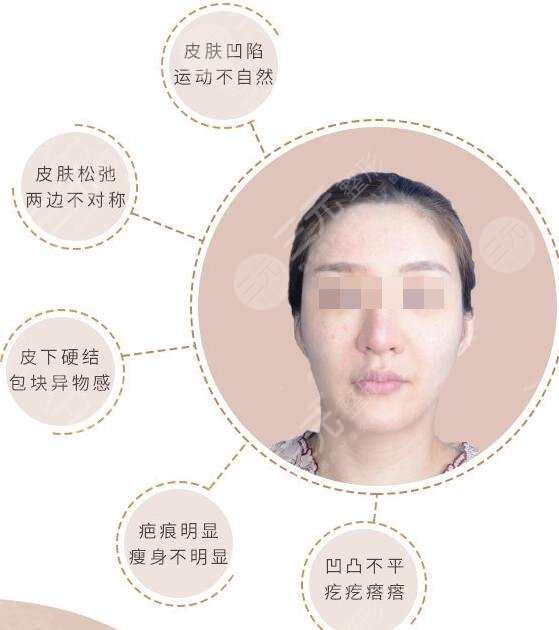 吸脂失败修复