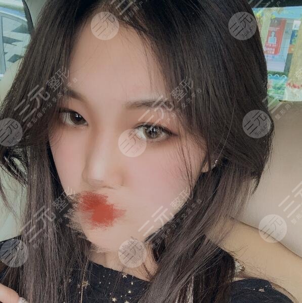 九院张余光双眼皮怎么样?术后日记分享,美腻又自然!