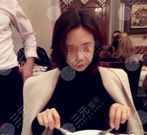 激光抗衰老真人案例前