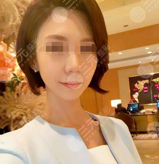 激光抗衰老真人案例后