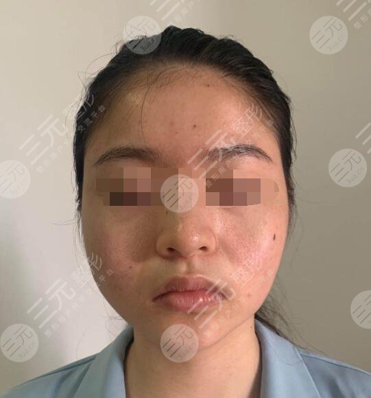 激光抗衰老案例反馈前