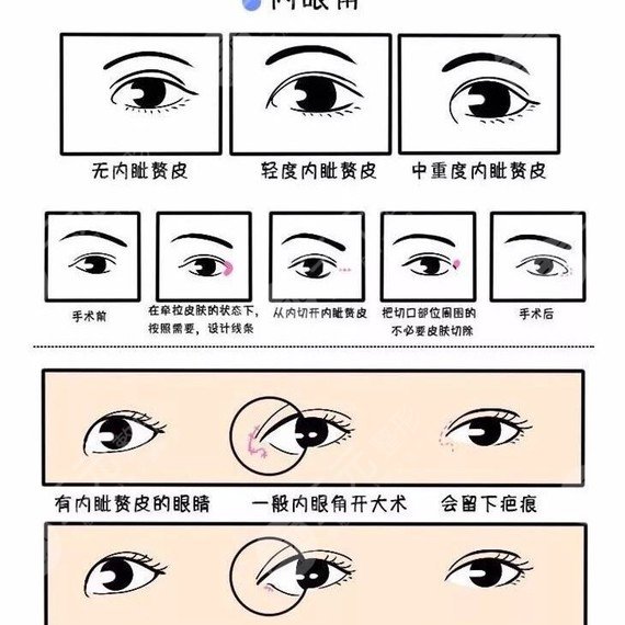 开眼角手术