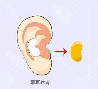 假体加耳软骨隆鼻手术