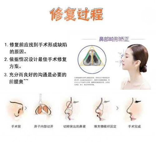 膨体隆鼻假体取出手术