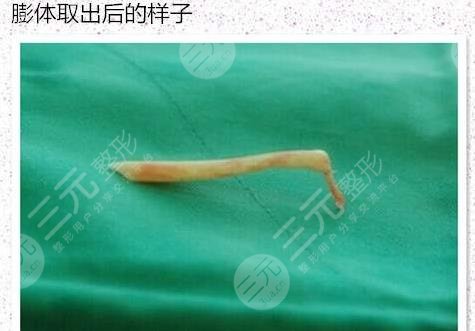 膨体隆鼻假体取出手术多少钱