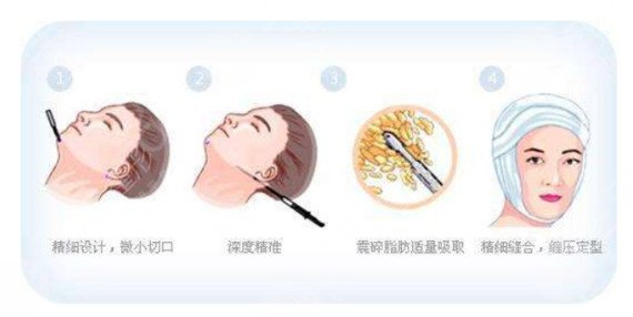 面部光纤溶脂后需要注意什么