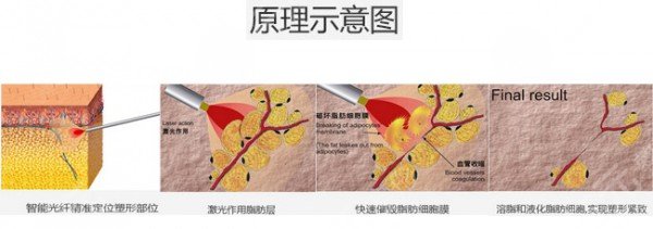 光纤溶脂瘦脸多久恢复