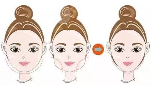 面部光纤溶脂多少钱