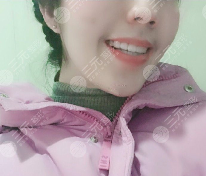 牙齿矫正案例