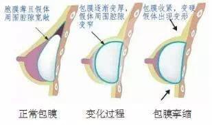 隆乳手术风险