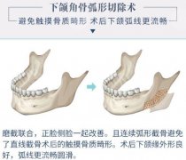 下颌角截骨多长时间能够消肿？这些事做好，消肿更快！
