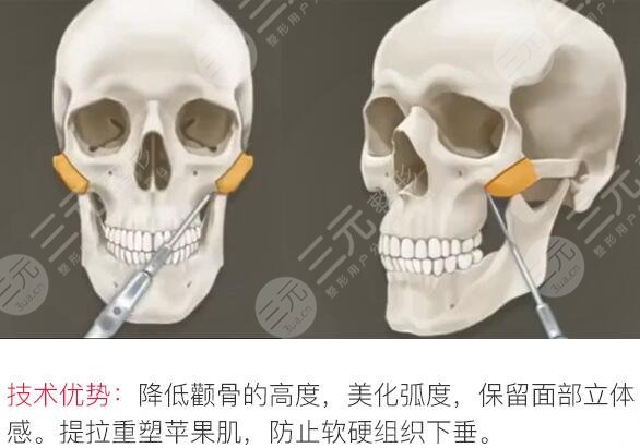 颧骨手术