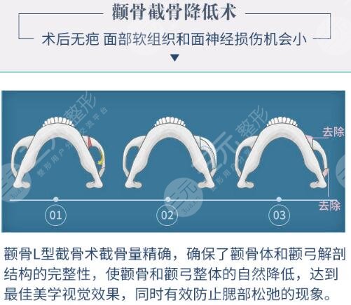 颧骨磨骨