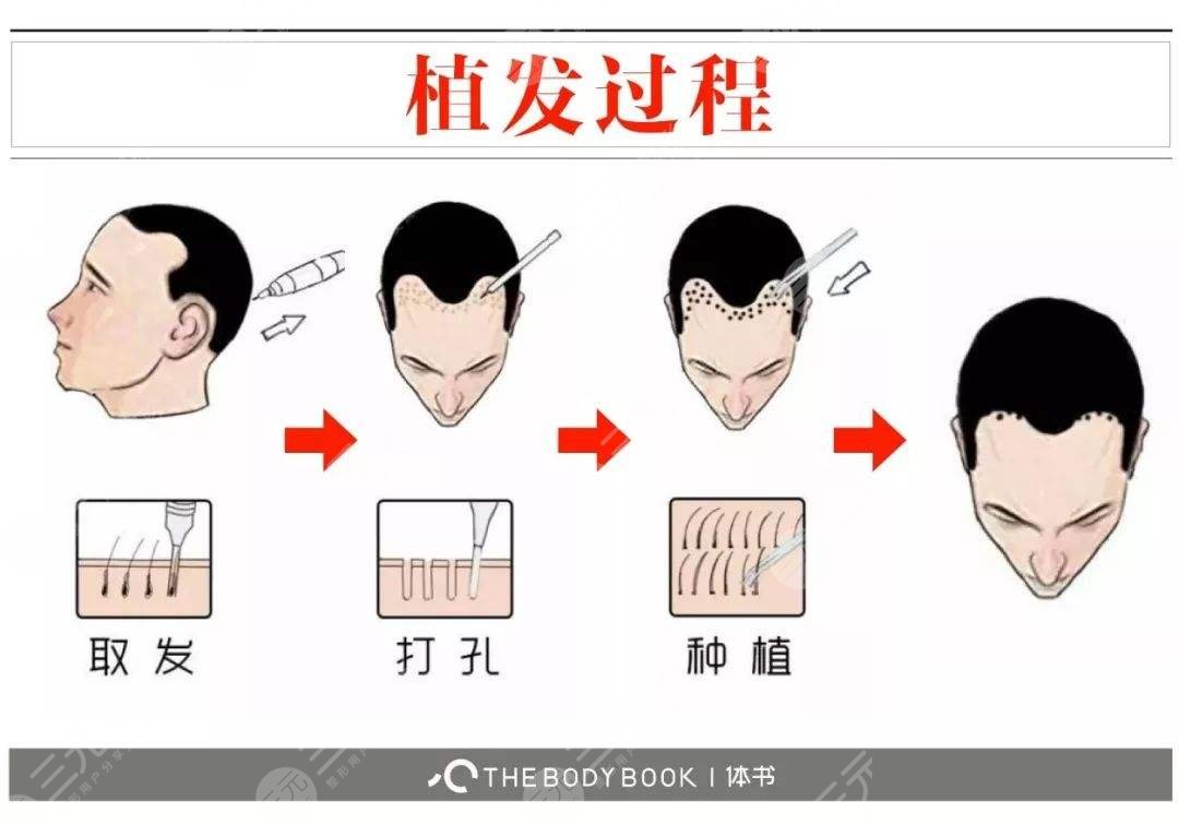 植发手术价钱