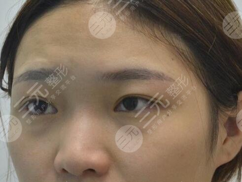 武汉中南医院整形美容科黄磊案例前
