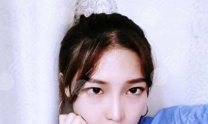 武汉中南医院整形美容科黄磊案例后