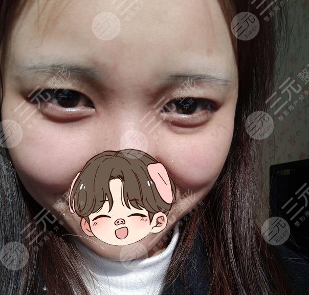 沈阳杏林张莹莹医生去眼袋案例