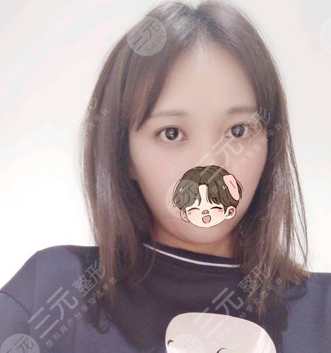 沈阳杏林张莹莹医生去眼袋案例