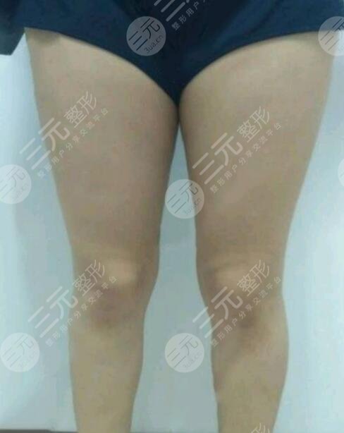 大腿吸脂案例