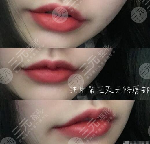 丰唇果图