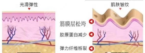 注射玻尿酸丰面颊优点