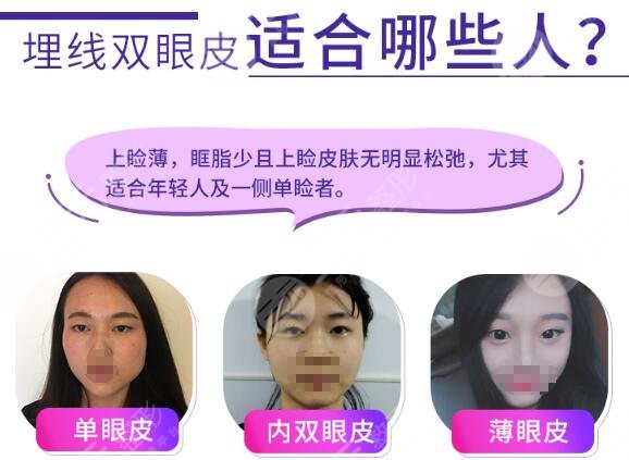埋线双眼皮失败率高吗