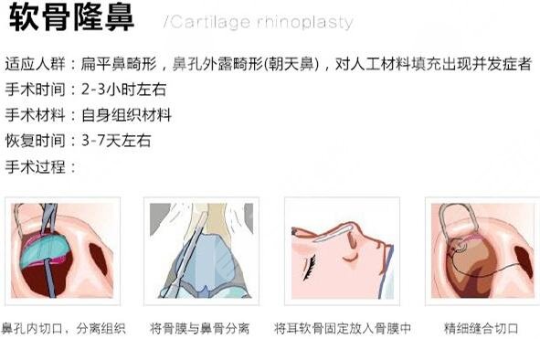 自体软骨隆鼻手术