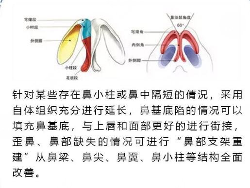 自体软骨隆鼻优点