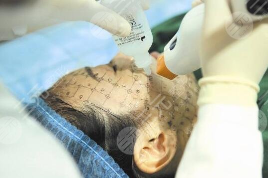 热玛吉紧肤除皱保持几年?