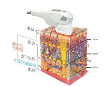 热玛吉的技术特点