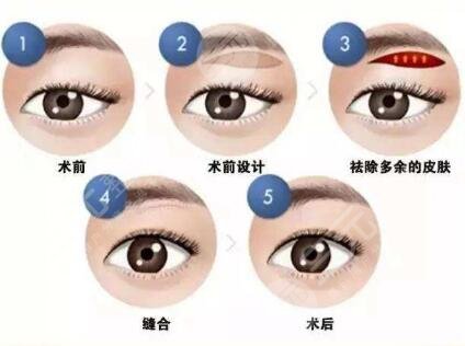 切眉术会留下伤疤吗?