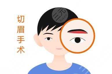 切眉术进程介绍