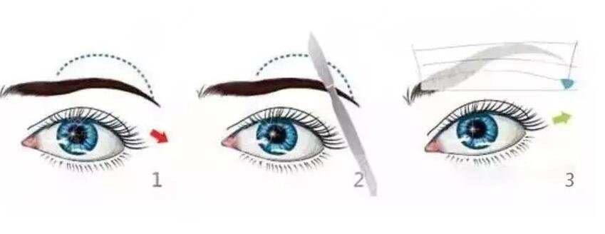 切眉术后的护理注意事项