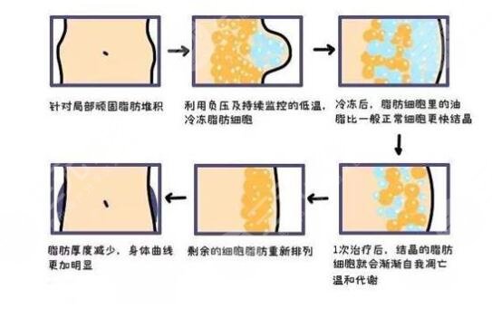 酷塑冷冻减脂的注意事项