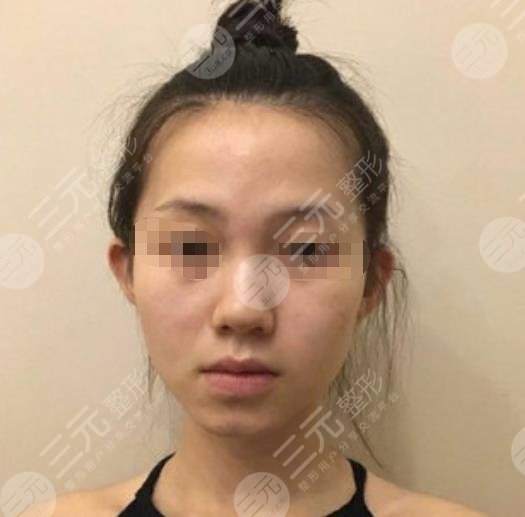 武汉中南医院整形科隆鼻整形案例