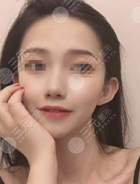 武汉中南医院整形科隆鼻整形案例