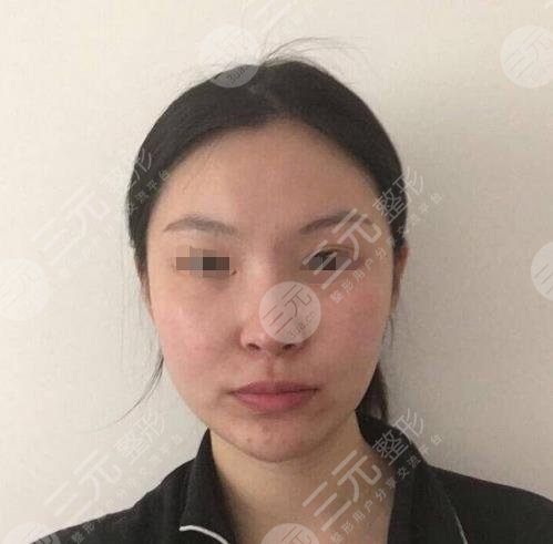 上海九院的整容科下颌角案例