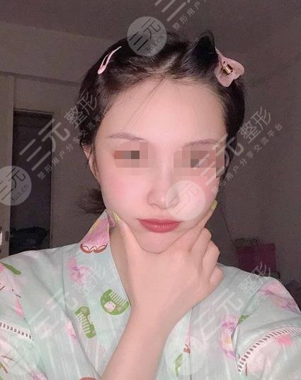上海九院的整容科下颌角案例