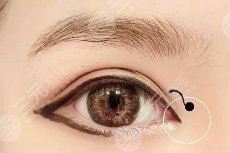 开眼角有哪几种方法