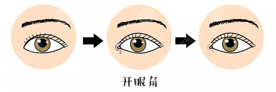 开眼角手术术后护理