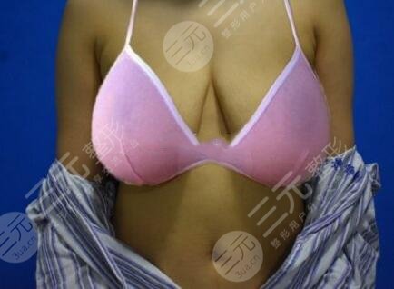 巨乳缩小术案例