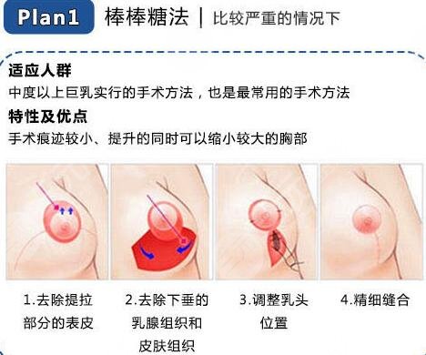 巨乳缩小手术过程