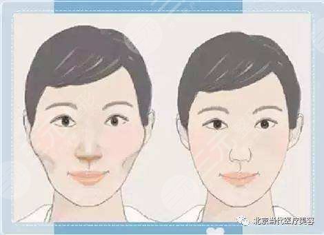 颧弓突出怎么办