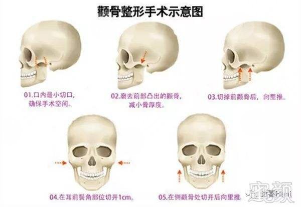 颧骨颧弓缩小手术